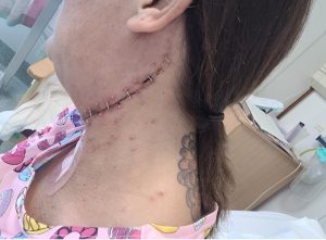After operation
