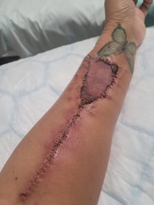 Sharon's arm